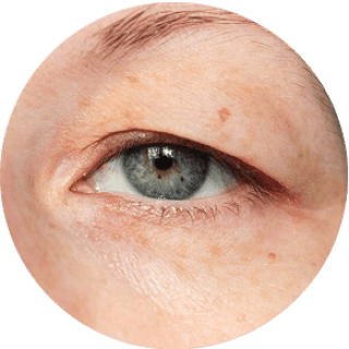 Droopy Eyelids