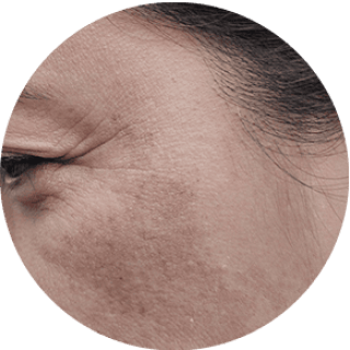 Dull Complexion